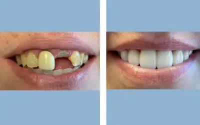 Before and After
